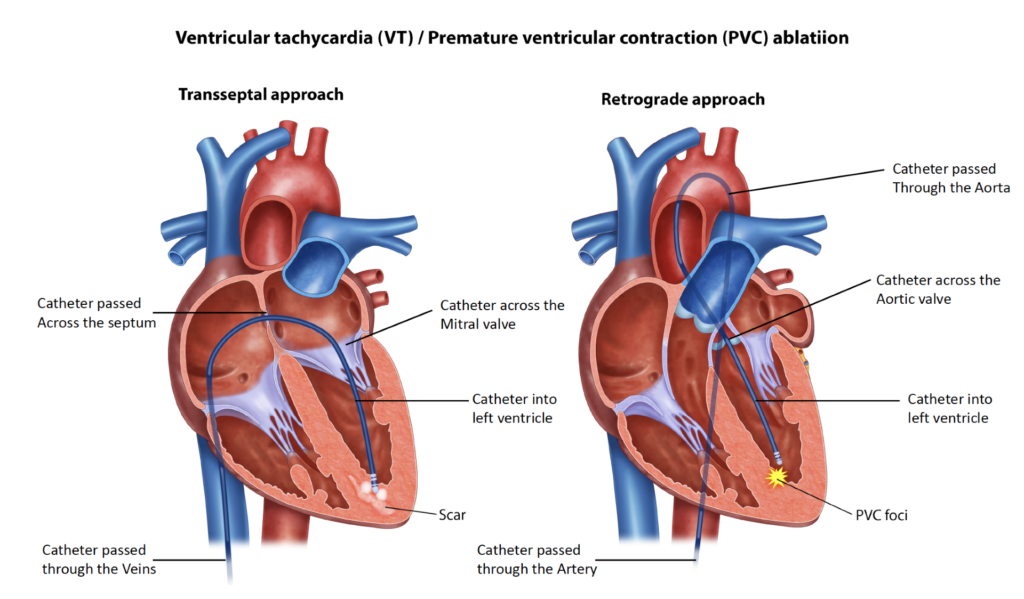 PVC VT Ablation Melbourne Heart Group